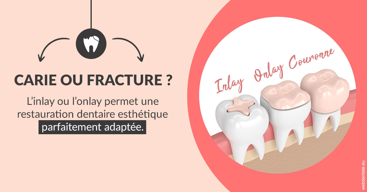 https://dr-nigoghossian-cecile.chirurgiens-dentistes.fr/T2 2023 - Carie ou fracture 2