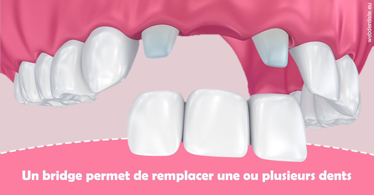 https://dr-nigoghossian-cecile.chirurgiens-dentistes.fr/Bridge remplacer dents 2