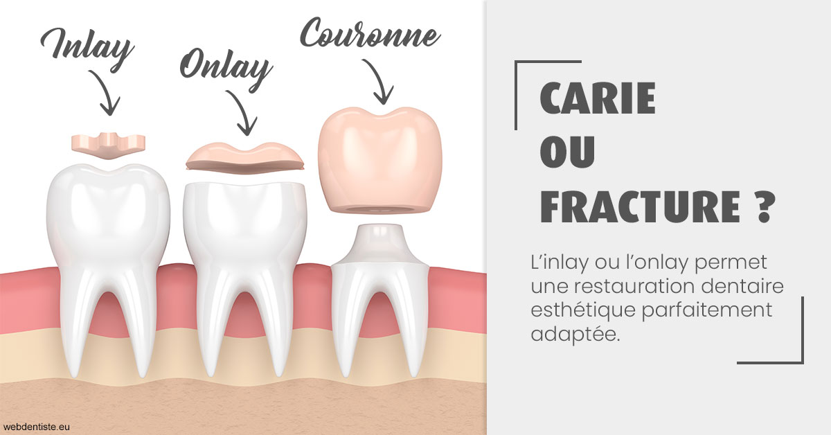 https://dr-nigoghossian-cecile.chirurgiens-dentistes.fr/T2 2023 - Carie ou fracture 1