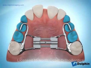 Disjonction orthodontique